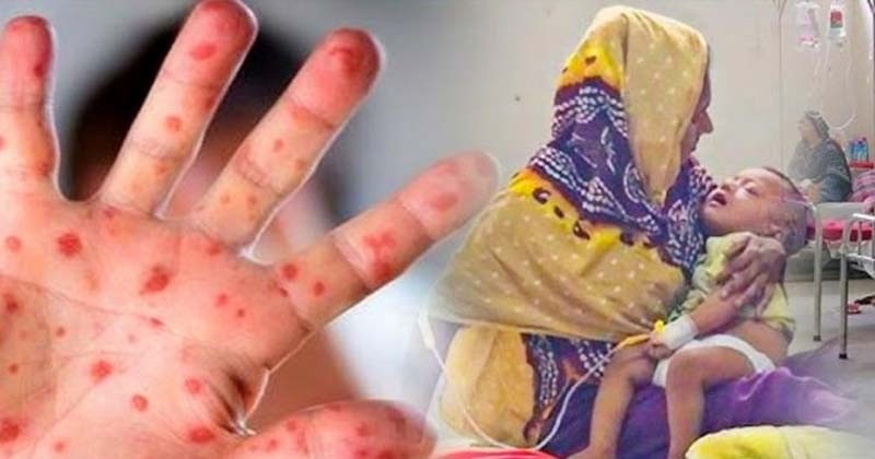 হামের উপসর্গ নিয়ে দেশে আরও ১১ শিশুর মৃত্যু